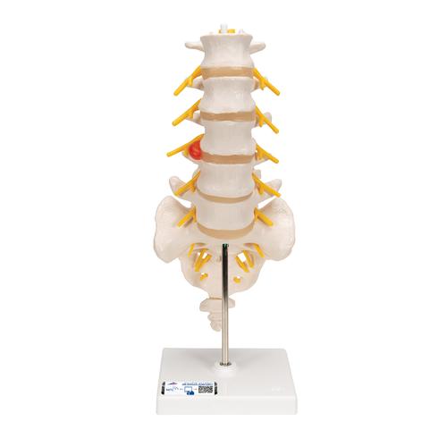 Human Lumbar Spinal Column Model with Dorso-Lateral Prolapsed Intervertebral Disc - 3B